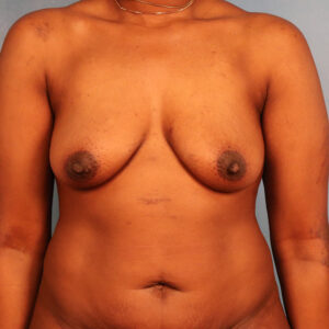 Case--2635 | Before Breast 1