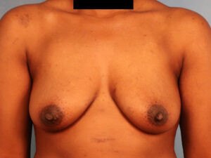 Case--60849 | Before Breast 1