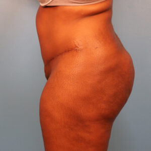 Case--60923 | After Tummy Tuck (Abdominoplasty) 2