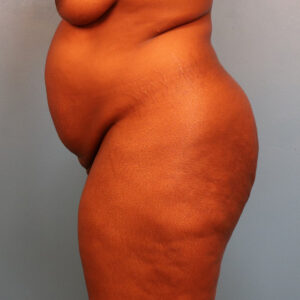 Case--60923 | Before Tummy Tuck (Abdominoplasty) 2
