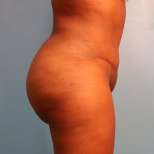 Case--61075 | After Tummy Tuck (Abdominoplasty) 2