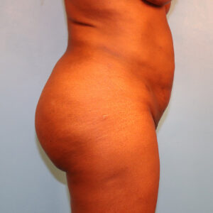 Case--61075 | Before Tummy Tuck (Abdominoplasty) 2
