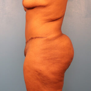 Case--61120 | After Tummy Tuck (Abdominoplasty) 2