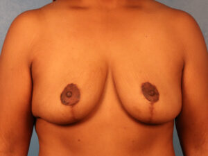 Case--61120 | After Breast 1