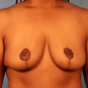 Case--3753 | After Breast 1