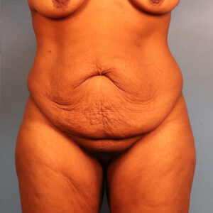 Case--61120 | Before Tummy Tuck (Abdominoplasty) 1
