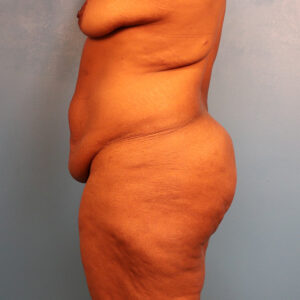 Case--61120 | Before Tummy Tuck (Abdominoplasty) 2