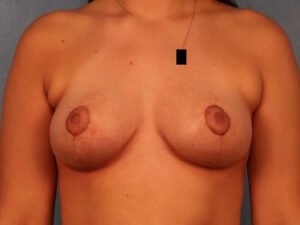 Case--61247 | After Breast 1
