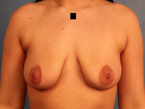 Case--61247 | Before Breast 1