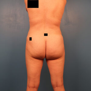 Case--2948 | After Body 1