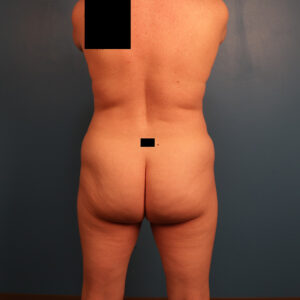 Case--2948 | Before Body 1