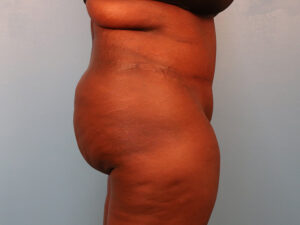 Case--61560 | After Tummy Tuck (Abdominoplasty) 2