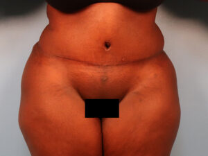 Case--61560 | After Tummy Tuck (Abdominoplasty) 1