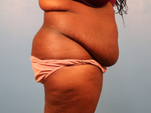Case--61560 | Before Tummy Tuck (Abdominoplasty) 2