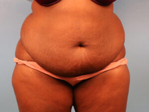 Case--61560 | Before Tummy Tuck (Abdominoplasty) 1