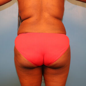Case--5154 | Before Body 1