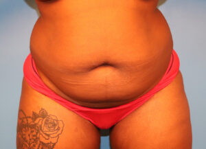 Case--5973 | Before Abdominoplasty 1