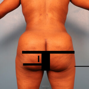 Case--5154 | After Body 1