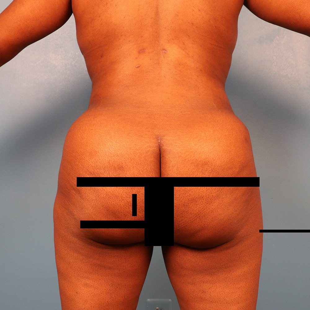 Case--5154 | After Liposuction