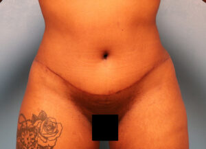 Case--5973 | After Abdominoplasty 1