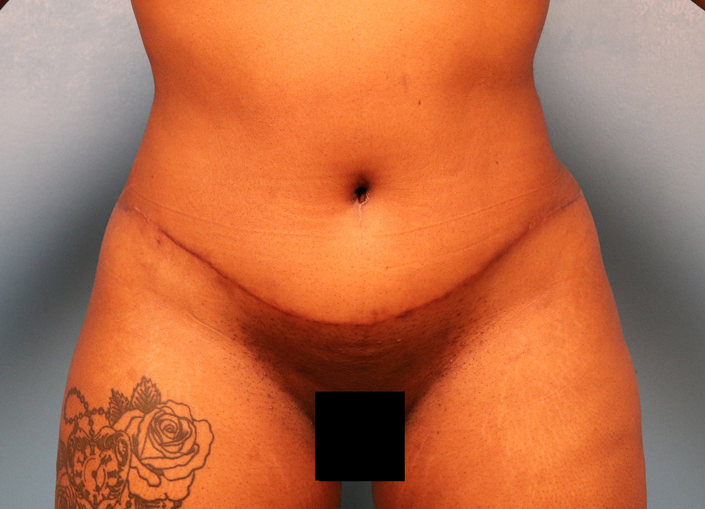 Case--5973 | After Body