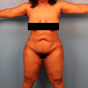 Case--5257 | After Body 1