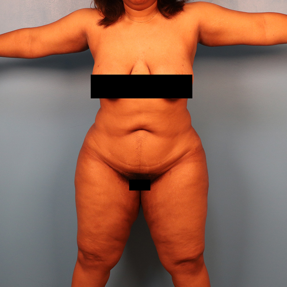 Case--5257 | After Liposuction