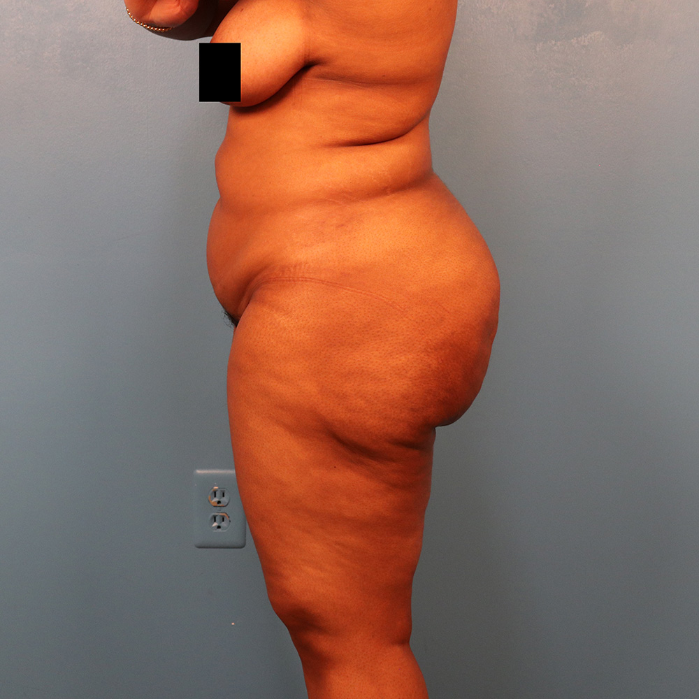 Case--5257 | After Liposuction 2