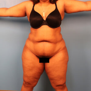 Case--5257 | Before Body 1
