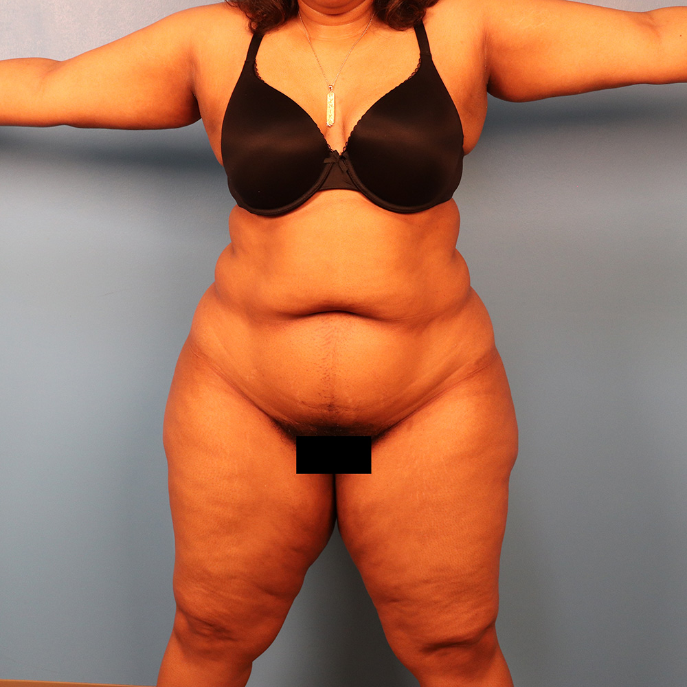 Case--5257 | Before Liposuction