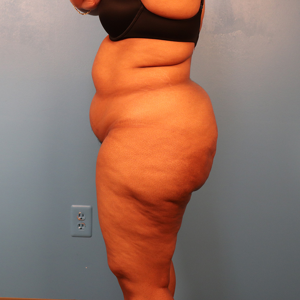 Case--5257 | Before Liposuction 2