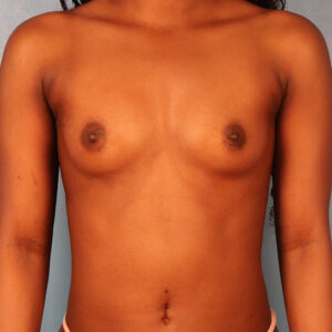 Case--9511 | Before Breast 1