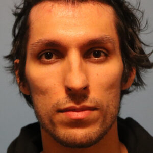 Case--3823 | Before Rhinoplasty 1