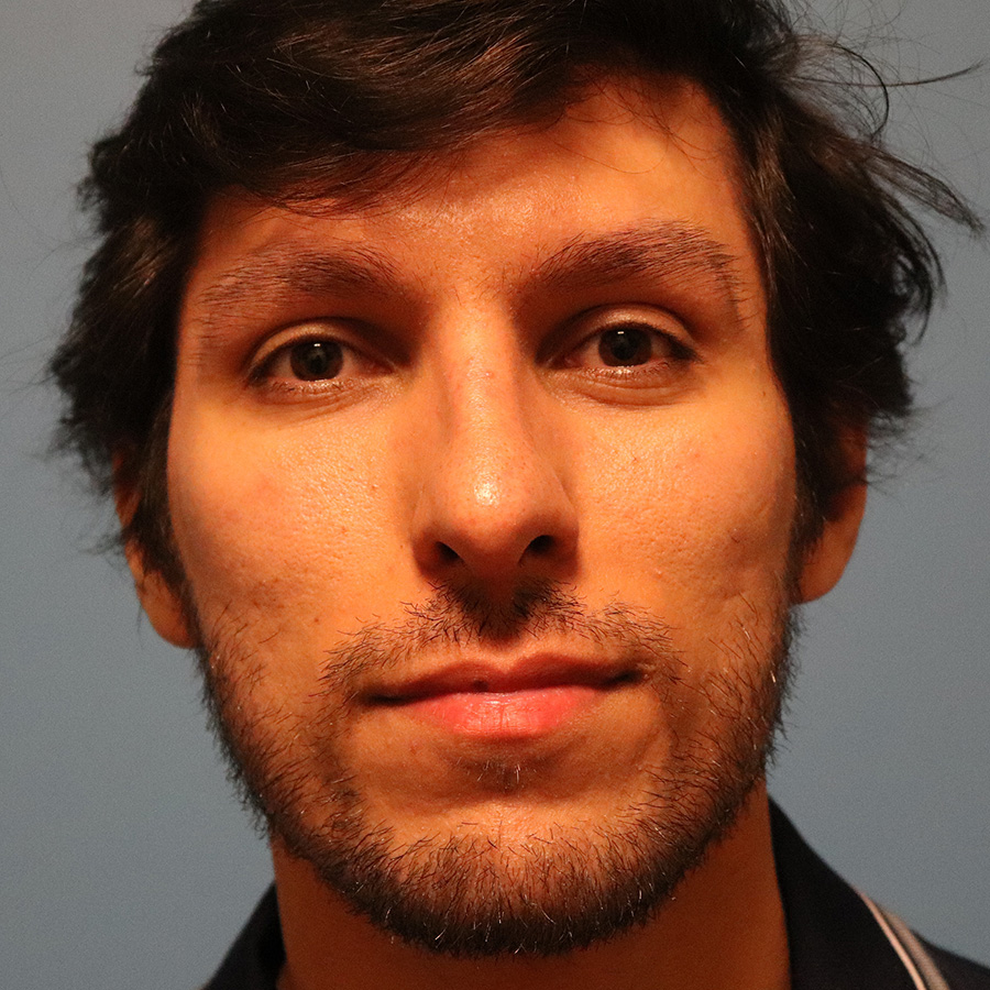 Case--3823 | After Rhinoplasty