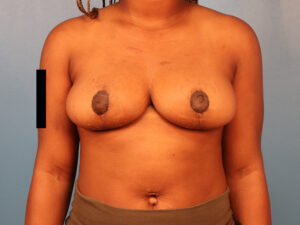 Case--63358 | After Breast 1