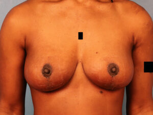 Case--63437 | After Breast 1