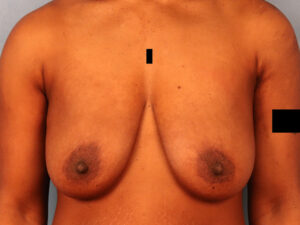 Case--63437 | Before Breast 1