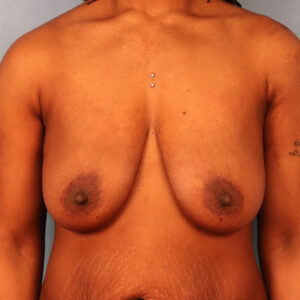 Case--8382 | Before Breast 1