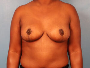 Case--63475 | After Breast 1