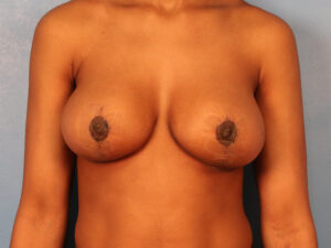 Case--63496 | After Breast 1