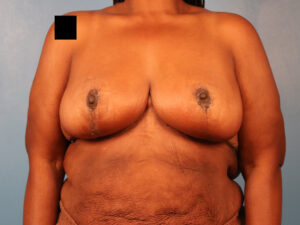 Case--63829 | After Breast 1