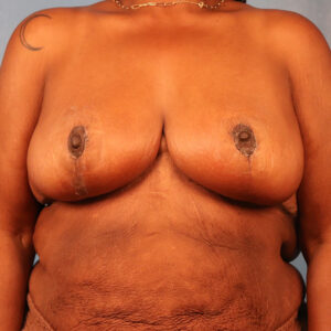 Case--5669 | After Bilateral Reduction Mammaplasty (Breast Reduction) 1