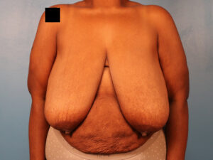 Case--63829 | Before Breast 1