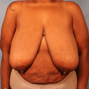 Case--5669 | Before Bilateral Reduction Mammaplasty (Breast Reduction) 1