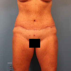 Case--63887 | After Tummy Tuck (Abdominoplasty) 1