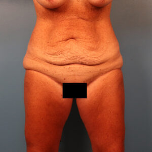 Case--63887 | Before Tummy Tuck (Abdominoplasty) 1