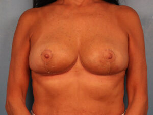 Case--65622 | After Breast 1