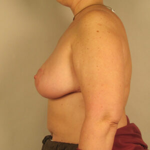 Case--1213 | After Bilateral Reduction Mammaplasty (Breast Reduction) 2