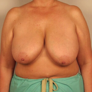 Case--1213 | Before Bilateral Reduction Mammaplasty (Breast Reduction) 1
