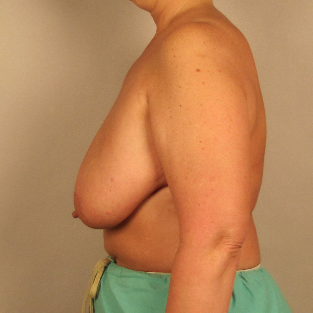 Case--1213 | Before Bilateral Reduction Mammaplasty (Breast Reduction) 2
